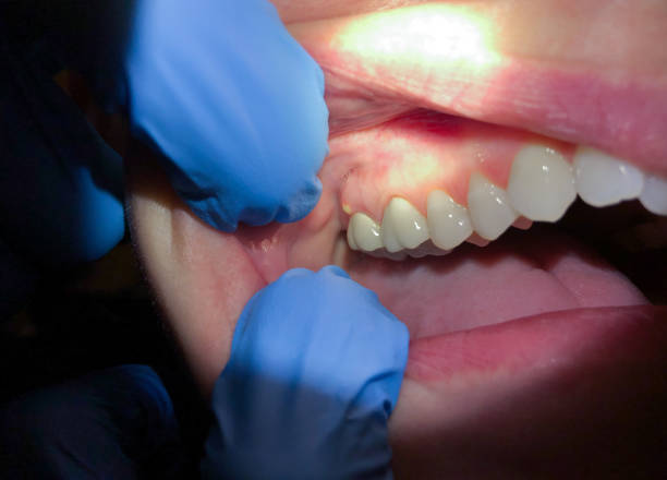 Best Emergency Root Canal Treatment in Webster, SD